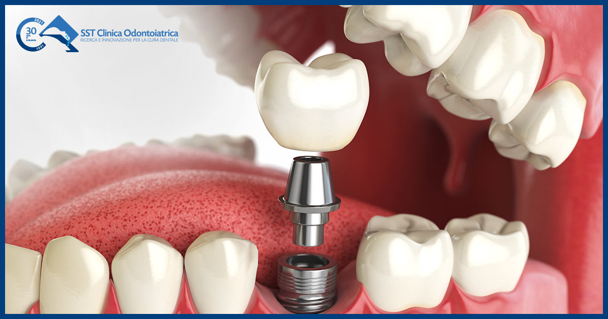 Sigarette elettroniche: tutti i rischi che possono causare alla salute dei  denti - SST Clinica Odontoiatrica