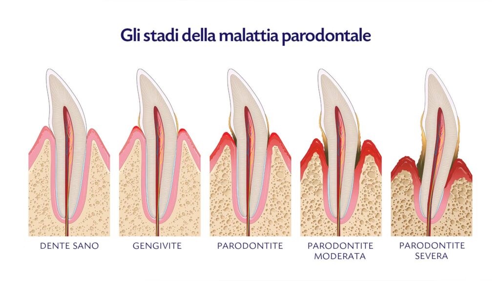 cura-parodontite