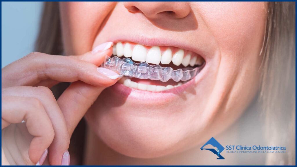 allineatori dentali allineatori dentali